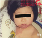 血管瘤病理图片图1-图20(图1)
