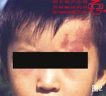 血管瘤病理图片图1-图20(图2)
