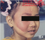 血管瘤病理图片图1-图20(图4)