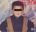 血管瘤病理图片图1-图20(图5)