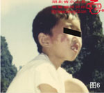 血管瘤病理图片图1-图20(图6)