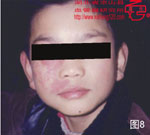 血管瘤病理图片图1-图20(图8)
