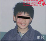 血管瘤病理图片图1-图20(图10)