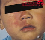血管瘤病理图片图1-图20(图11)