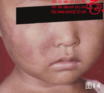 血管瘤病理图片图1-图20(图14)
