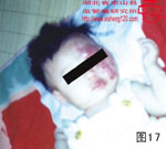 血管瘤病理图片图1-图20(图17)