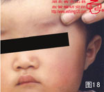 血管瘤病理图片图1-图20(图18)