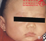 血管瘤病理图片图1-图20(图19)