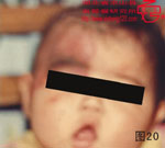 血管瘤病理图片图1-图20(图20)