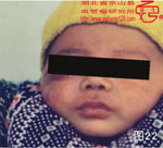 血管瘤病理图片图21-图40(图1)
