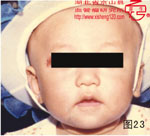 血管瘤病理图片图21-图40(图2)