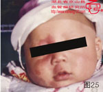 血管瘤病理图片图21-图40(图4)
