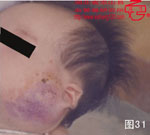 血管瘤病理图片图21-图40(图10)
