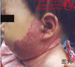 血管瘤病理图片图21-图40(图14)