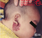 血管瘤病理图片图21-图40(图18)
