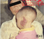 血管瘤病理图片图21-图40(图19)