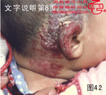 血管瘤病理图片图41-图60(图2)
