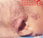 血管瘤病理图片图41-图60(图3)