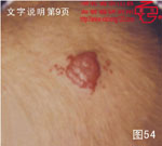 血管瘤病理图片图41-图60(图14)