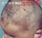 血管瘤病理图片图41-图60(图15)
