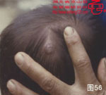 血管瘤病理图片图41-图60(图16)