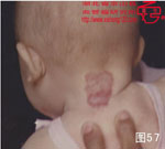 血管瘤病理图片图41-图60(图17)