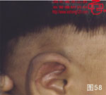血管瘤病理图片图41-图60(图18)