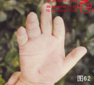 血管瘤病理图片图61-图80(图1)
