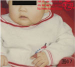 血管瘤病理图片图61-图80(图6)
