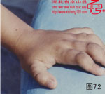 血管瘤病理图片图61-图80(图11)