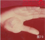 血管瘤病理图片图61-图80(图12)