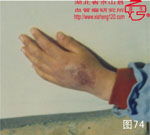 血管瘤病理图片图61-图80(图13)