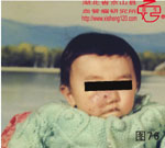 血管瘤病理图片图61-图80(图15)