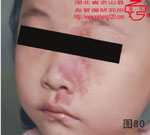 血管瘤病理图片图61-图80(图19)