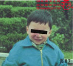 血管瘤病理图片图81-图100(图6)
