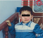 血管瘤病理图片图81-图100(图10)