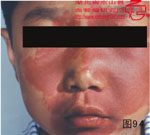 血管瘤病理图片图81-图100(图13)