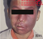 血管瘤病理图片图81-图100(图14)