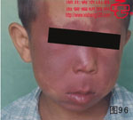 血管瘤病理图片图81-图100(图15)
