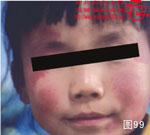 血管瘤病理图片图81-图100(图18)