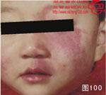 血管瘤病理图片图81-图100(图19)