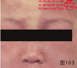 血管瘤病理图片图101-图120(图2)