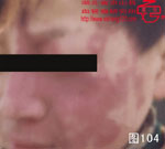 血管瘤病理图片图101-图120(图3)