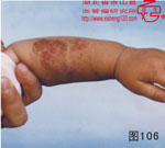 血管瘤病理图片图101-图120(图5)