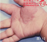 血管瘤病理图片图101-图120(图11)