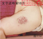 血管瘤病理图片图101-图120(图12)