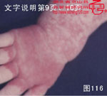 血管瘤病理图片图101-图120(图15)