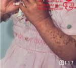 血管瘤病理图片图101-图120(图16)
