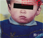 血管瘤病理图片图121-图140(图7)