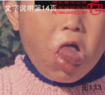 血管瘤病理图片图121-图140(图13)